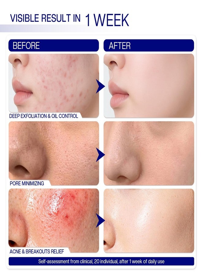 Morovan Glycolic Acid Pads 30%: Dual-Sided Face Exfoliator for Blemishes and Deep Cleaning, Clarifying Skin Tone, At-Home Peel, 65 Pads - Image 4